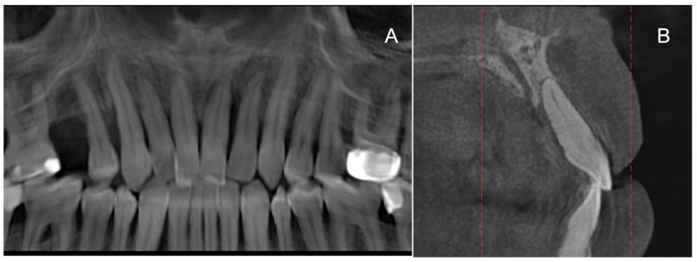 Dynamic navigation planning screens from the study on immediate implant placement