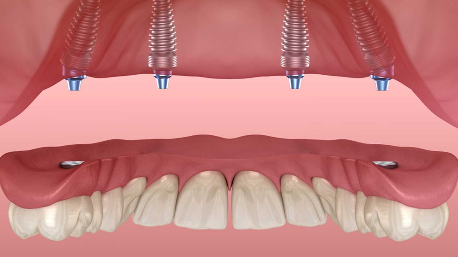 Illustration of a full-arch bridge on four implants