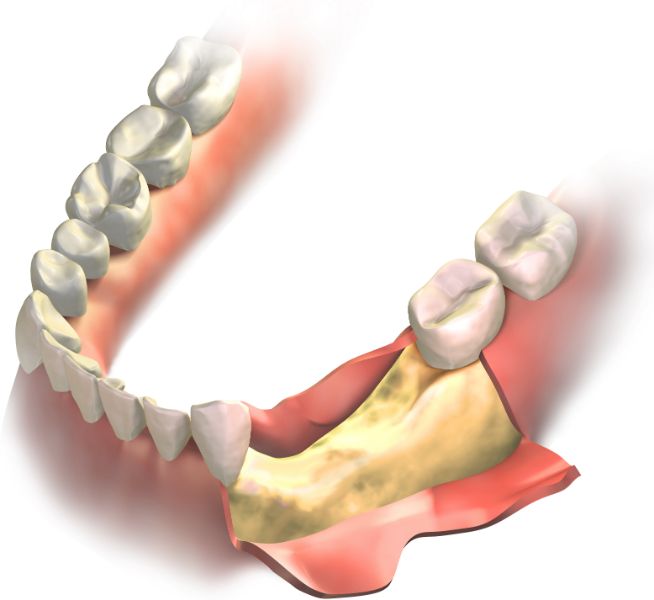 Illustration of jaw bone assessed before implant placement