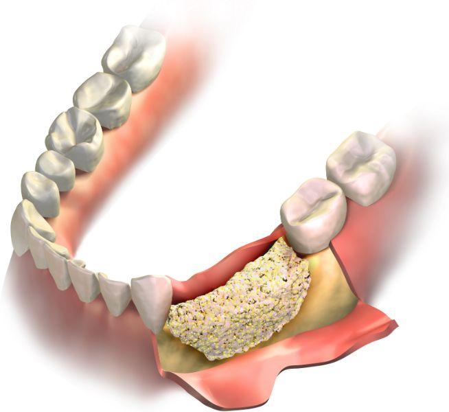 Illustration of guided bone regeneration before implant placement