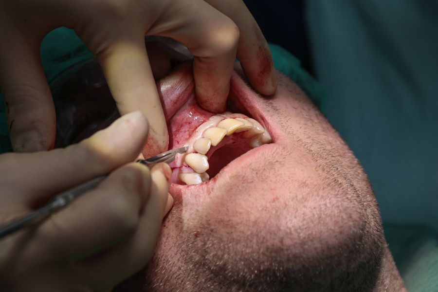 Examination of a healing extraction site