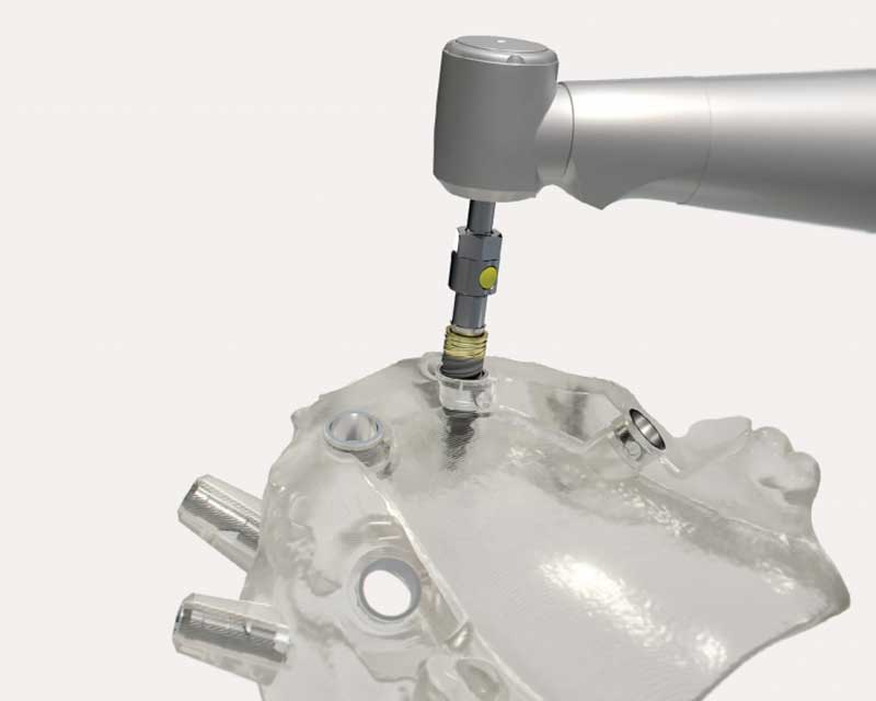 3D printed surgical guide for fully guided implant surgery