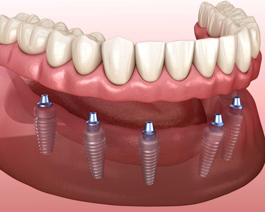 Illustration of same-day teeth: a full-arch bridge on six implants