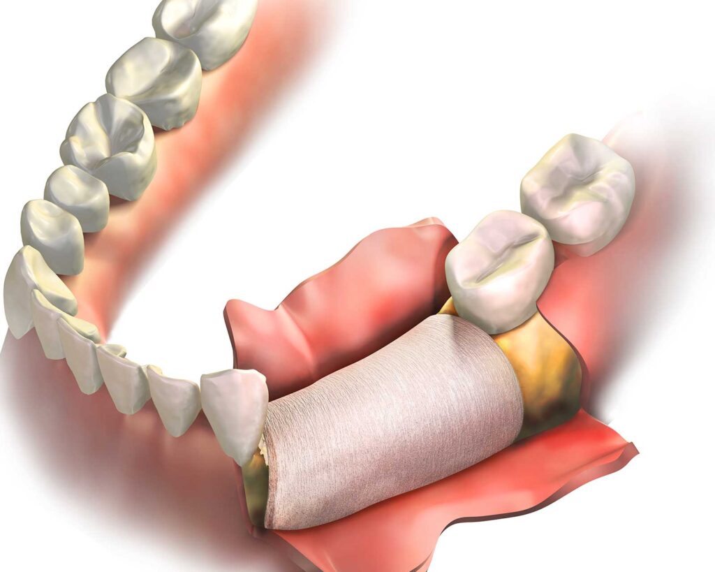 Illustration of bone loss that may call for a bone graft before implants