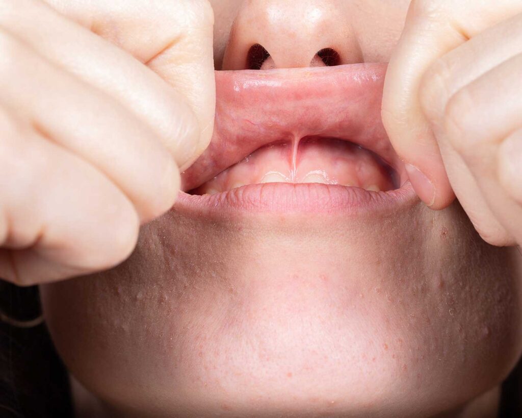 Examination of the inside of the lip before an oral biopsy