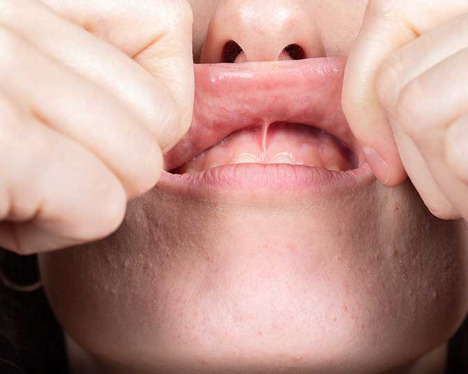 Upper lip frenum before a frenectomy