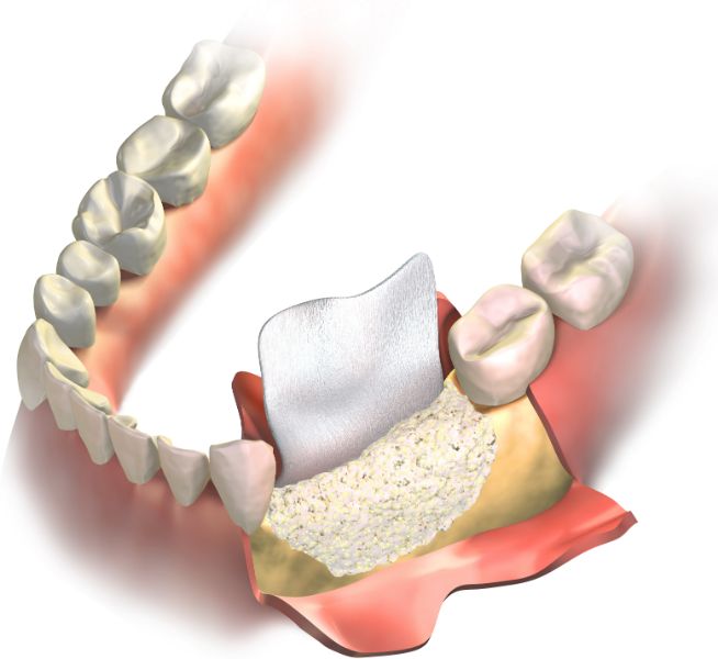 Illustration of bone grafting with a membrane covering the graft