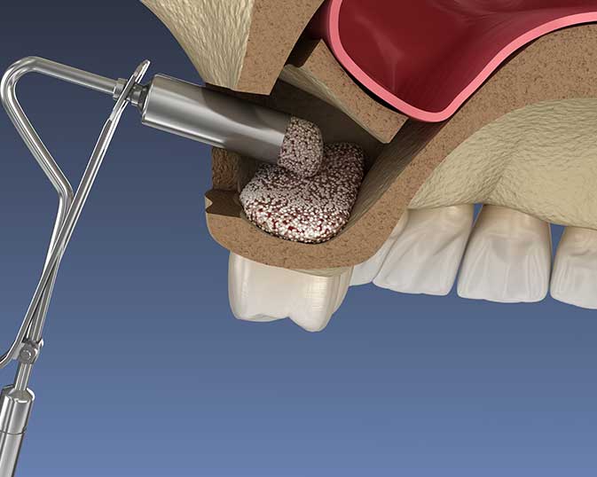 Illustration of a lateral sinus lift before healing