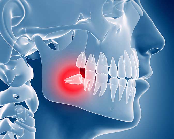 Illustration of an impacted wisdom tooth before wisdom teeth removal recovery