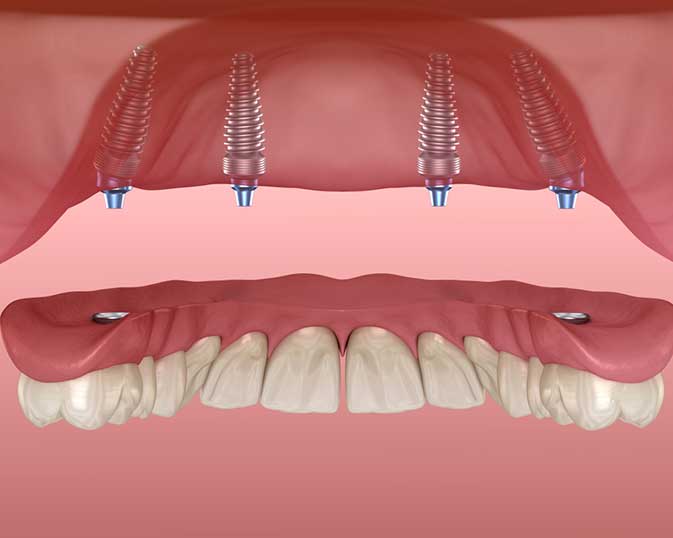 Illustration of an All-on-4 full-arch bridge on implants