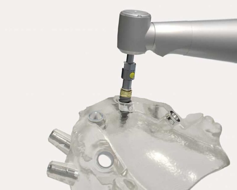 3D printed surgical guide, the alternative to freehand implant surgery