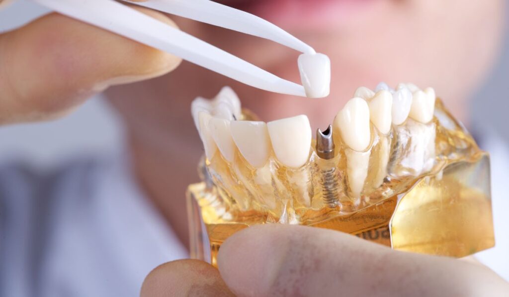 Implant model used at consultation to explain the cost of dental implants