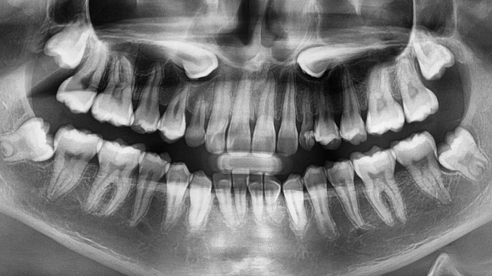 Panoramic X-ray showing impacted teeth